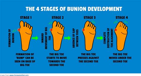 HAV (Hallux abducto valgus deformity) or ‘bunions’ - Harding Podiatry