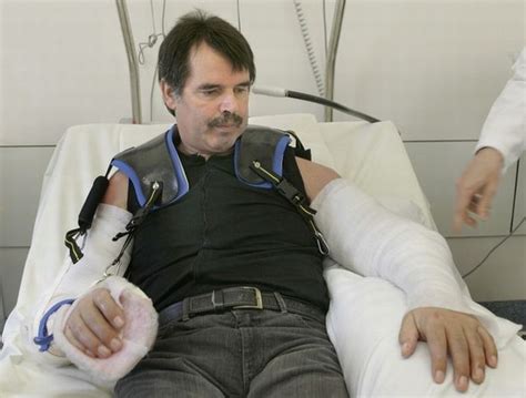 The first in the world complete double arm transplant (13 pics ...