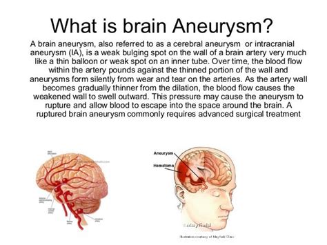 What Is A Ruptured Brain Aneurysm - Why Brain Aneurysms Need Watching Not Worrying / Ruptured ...