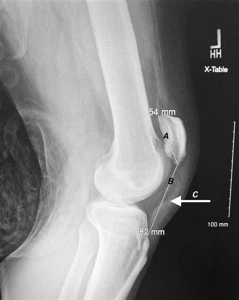 Patellar Tendon Rupture Repair