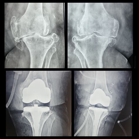 Single-Stage Bilateral Total Knee Replacement Surgery Success - Knee ...