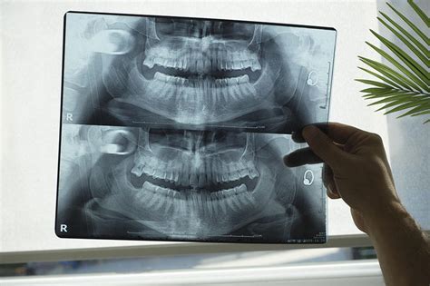 Protocols in Panoramic Radiographic Interpretation | School of Dentistry