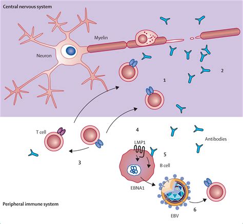 Infectious causes of multiple sclerosis - The Lancet Neurology