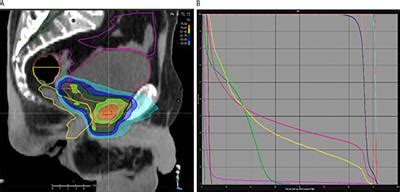 Frontiers | Salvage Radiotherapy for Macroscopic Local Recurrence ...