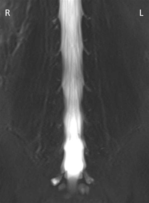 Image of T2-weighted coronal MRI image of multiple small Tarlov cysts ...