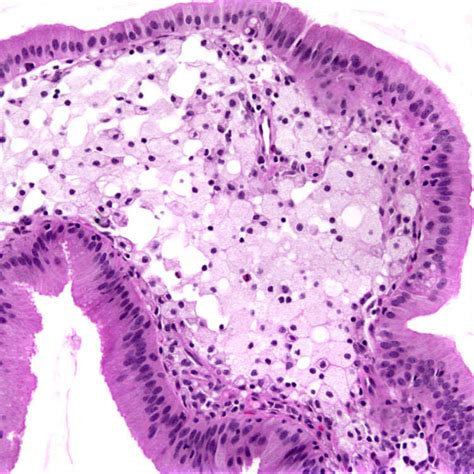 Cholesterol Polyps and Cholesterolosis | Basicmedical Key