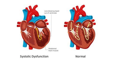 What ar Systolic Heart Failure Symptoms and Treatment | Dr. Raghu