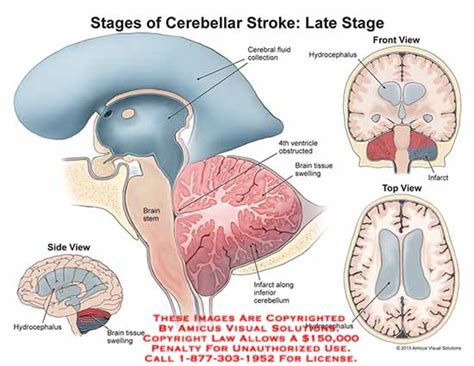 AMICUS Illustration of amicus,injury,stages,cerebellar,stroke,late,stage,cerebral,fluid ...