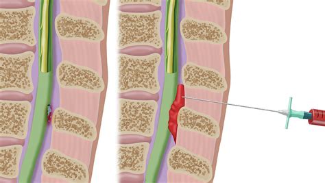 Epidural Blood Patch | ubicaciondepersonas.cdmx.gob.mx