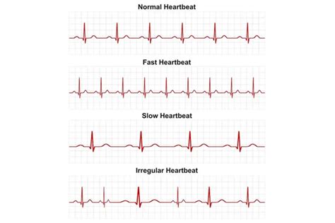 Heart Arrhythmias - Symptoms & Causes | Gleneagles Hospital