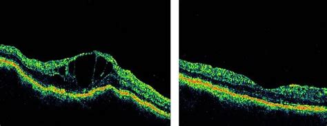 Macular edema and OCT - American Academy of Ophthalmology