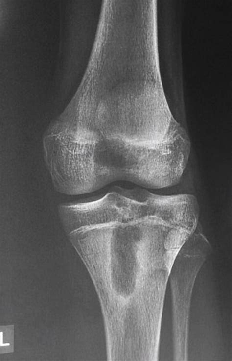 Brodie abscess | Radiology Case | Radiopaedia.org Pediatric Radiology, Oral Pathology, Radiology ...