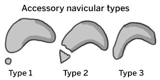 Accessory Navicular: Congenital Foot Deformity & Treatments