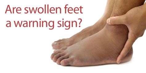 FootSmart Blog » How Serious Are Swollen Feet? | Swollen feet, Swelling feet, Ankle swelling causes