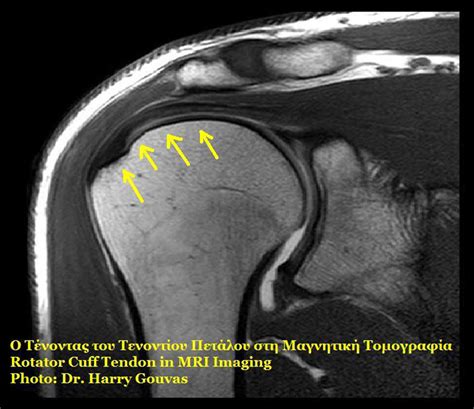 Rotator cuff symptoms | General center | SteadyHealth.com