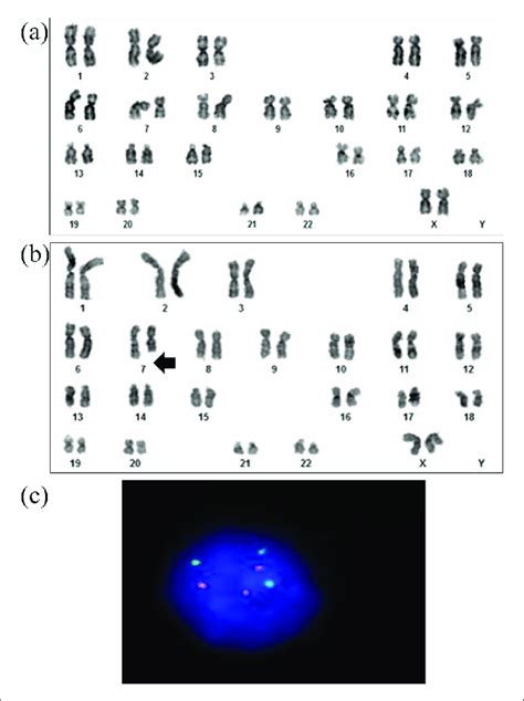 Conventional cytogenetic analysis showing (a) normal female karyotype... | Download Scientific ...