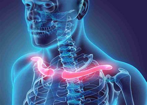 Broken Collar Bone Claim How Much? Clavicle Fracture Payouts