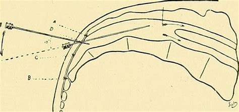 Caudal anaesthesia - Wikiwand