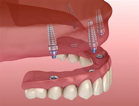 How Many Teeth Can Dental Implants Replace?