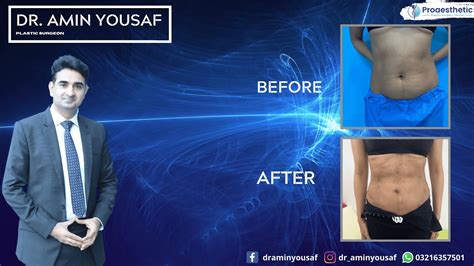 Belly fat removal surgery - Non surgical fat removal - Best Non surgical liposuction Pakistan ...