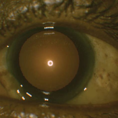 (PDF) Conjunctival chemosis: A case series of systemic causes