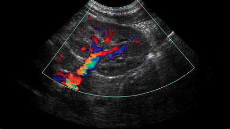 PROSTATE SURGERY: IS THERE AN ALTERNATIVE TO TURP? - Mayfair Diagnostics