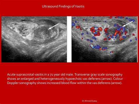 Imaging vastitis differentitis funiculitis seminal vesiculitis Dr Ahm…