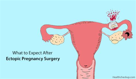 What To Expect After Ectopic Pregnancy Surgery by Dr. Himanshi