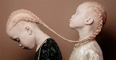 Demystifying the myths associated with albinism | The Guardian Nigeria News - Nigeria and World ...