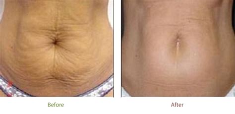 Laser Skin Tightening Before and After | El Dorado Hills