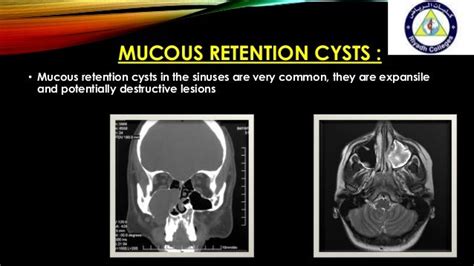 Maxillary Sinus Retention Cyst signs and symptoms - YolondahtyuiStachtyu