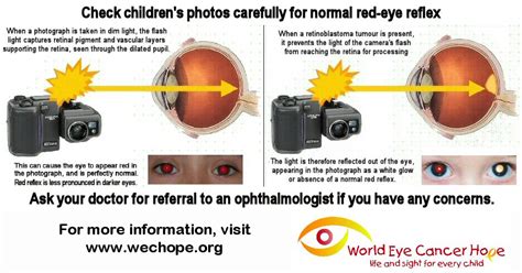 Fundal (Red Eye) Reflex and Red-Eye Reduction - WE C Hope