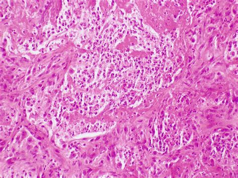 Candidiasis | Acute pneumonitis. | Dr. Yale Rosen Atlas of Pulmonary Pathology | Flickr