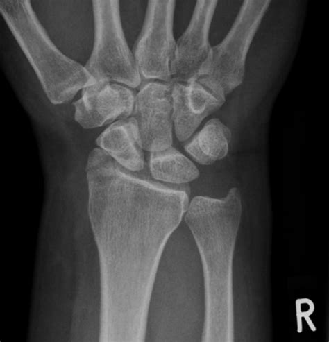 An intra-articular fracture of the radial styloid process is demonstrated, involving only the ...