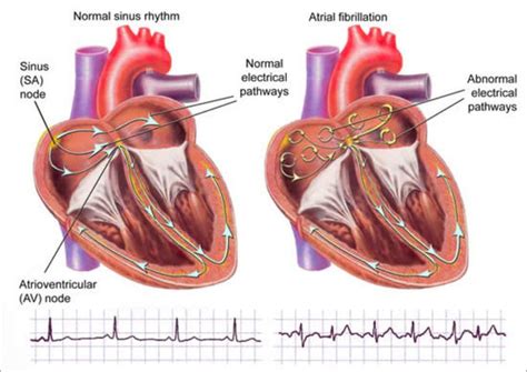 Normal sinus rhythm vs atrial fibrillation - MEDizzy