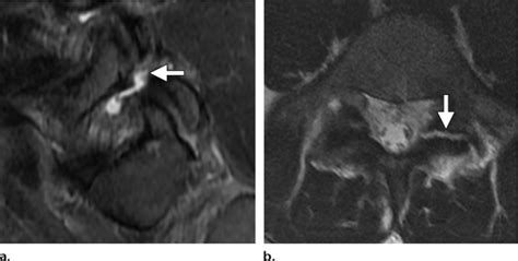 Stress fractures of the pars interarticularis in a 15-year-old female... | Download Scientific ...