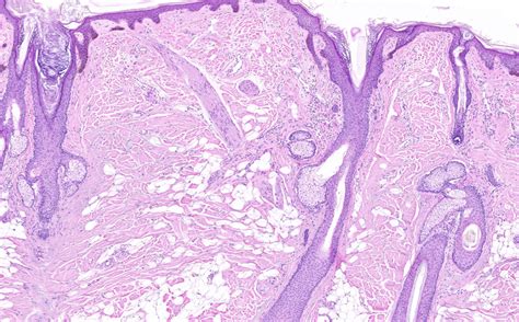 Acrochordon Histology