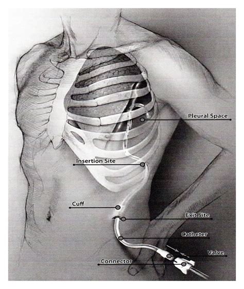 Tunneled Pleural Catheter