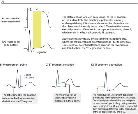 ECG in myocardial ischemia: ischemic changes in the ST segment & T-wave – The Cardiovascular