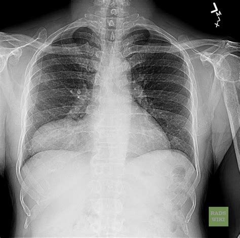 Pericardial cyst - wikidoc