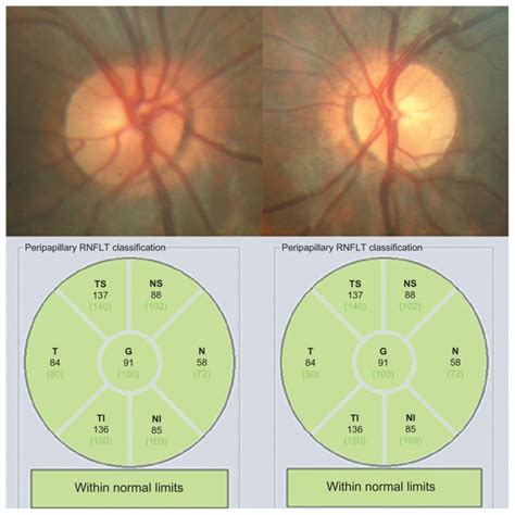 At the end of follow-up (4 months), a normal cup-to-disc ratio was seen... | Download Scientific ...