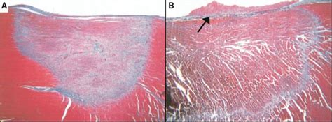 Catheter Cryoablation | Circulation: Arrhythmia and Electrophysiology