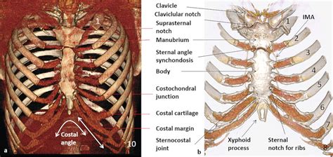 Costochondral Junction Syndrome