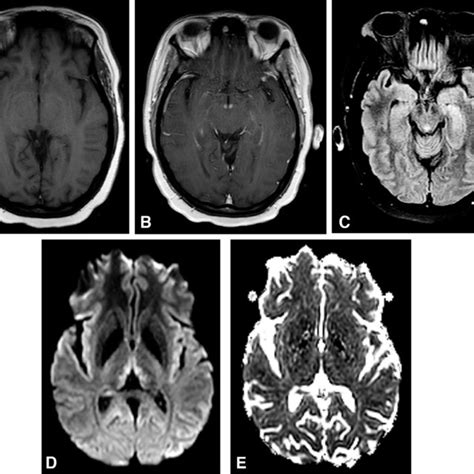 Brain MRI findings in Wernicke encephalopathy. Axial views. (A ...