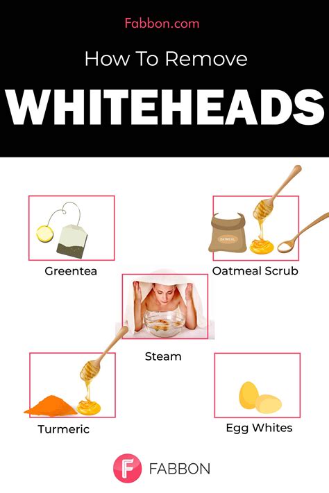 Know What are whiteheads and the home remedies to get rid of whiteheads! #whiteheadsremoval # ...