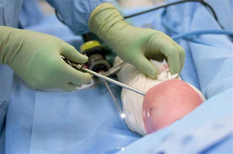 Knee Biopsy Surgery Photograph by Jim Varney/science Photo Library