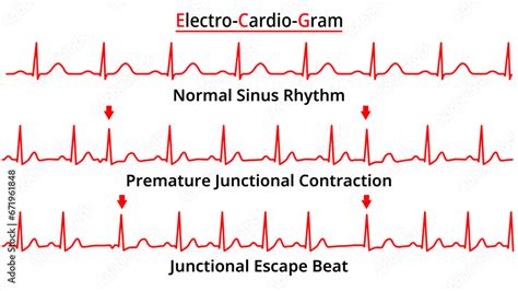 Set of ECG Common Abnormalities - Junctional Escape Beat - Premature Junctional Contraction PJC ...