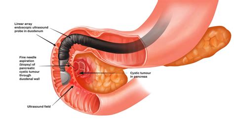 di Chimica una volta fine needle aspiration biopsy pancreas confusione ...