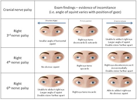 Diplopia — Maimonides Emergency Medicine Residency