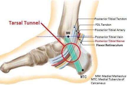 Tarsal Tunnel Syndrome